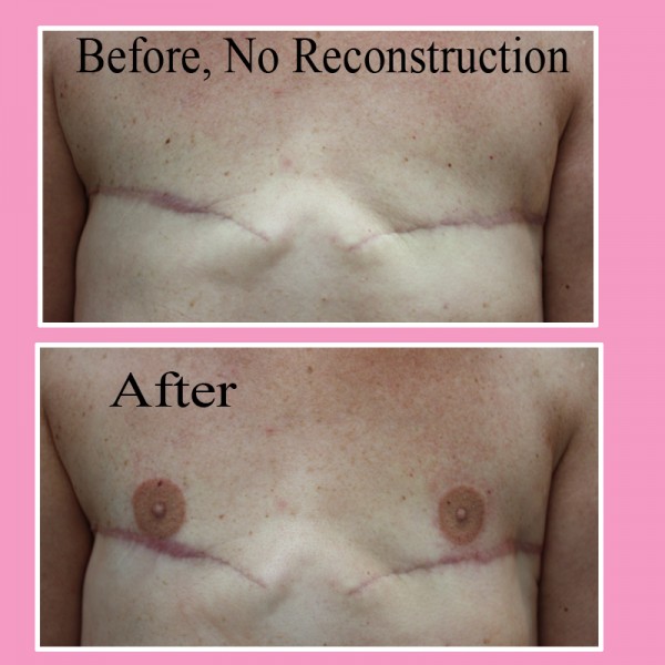 Before and after nipple areola tattoo example